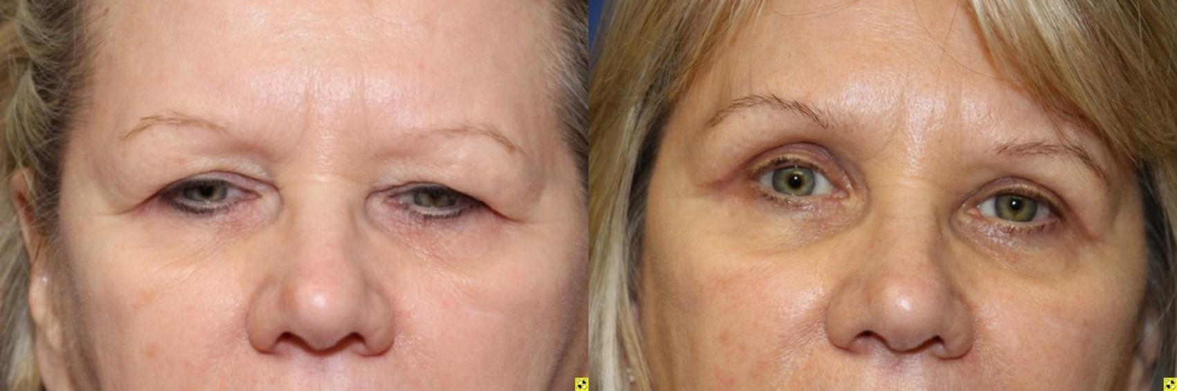 Before & After Eyelid Surgery Case 194 Front View in Ann Arbor, MI