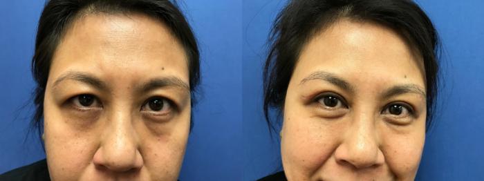 Before & After Eyelid Surgery Case 195 Front View in Ann Arbor, MI