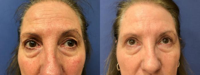 Before & After Eyelid Surgery Case 196 Front View in Ann Arbor, MI