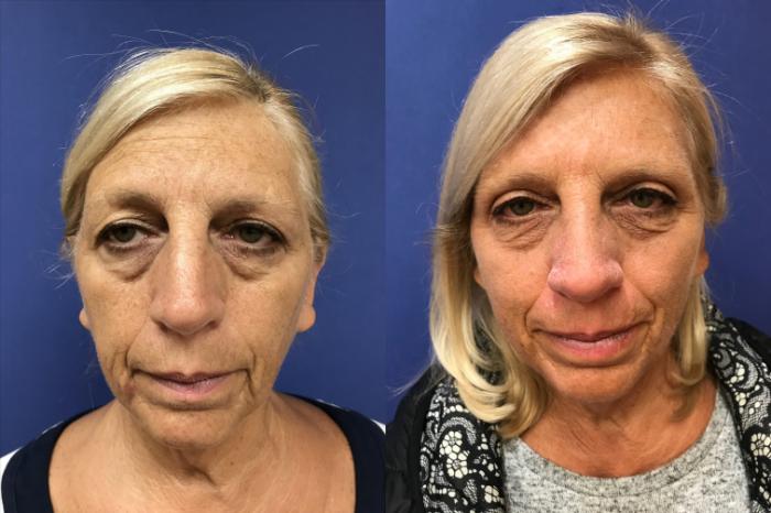 Before & After Eyelid Surgery Case 197 Front View in Ann Arbor, MI