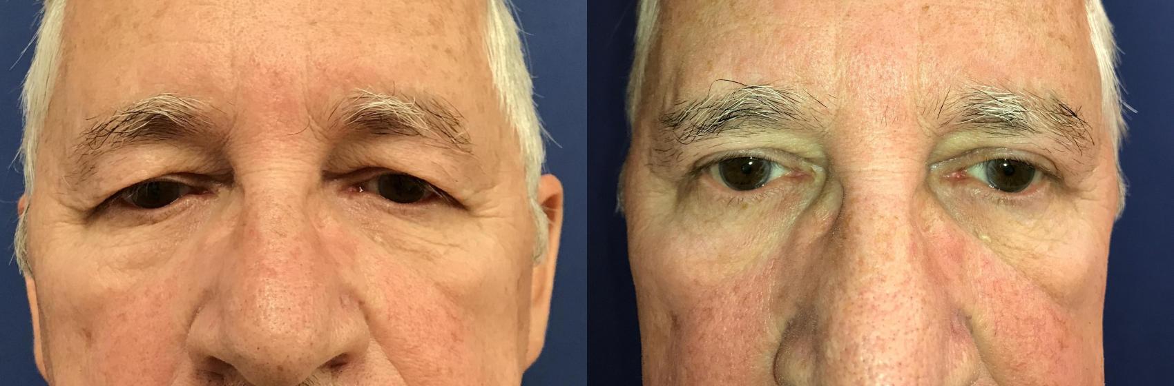 Before & After Eyelid Surgery Case 198 Front View in Ypsilanti, MI