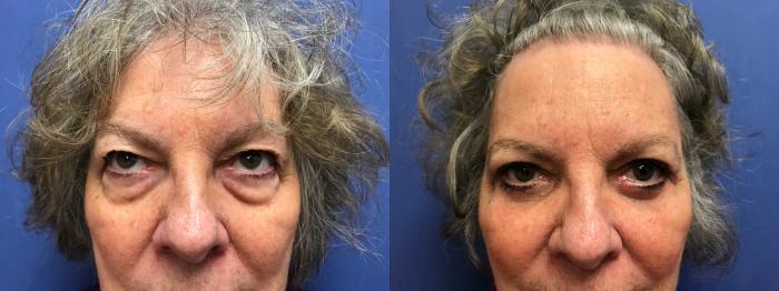 Before & After Eyelid Surgery Case 199 Front View in Ann Arbor, MI