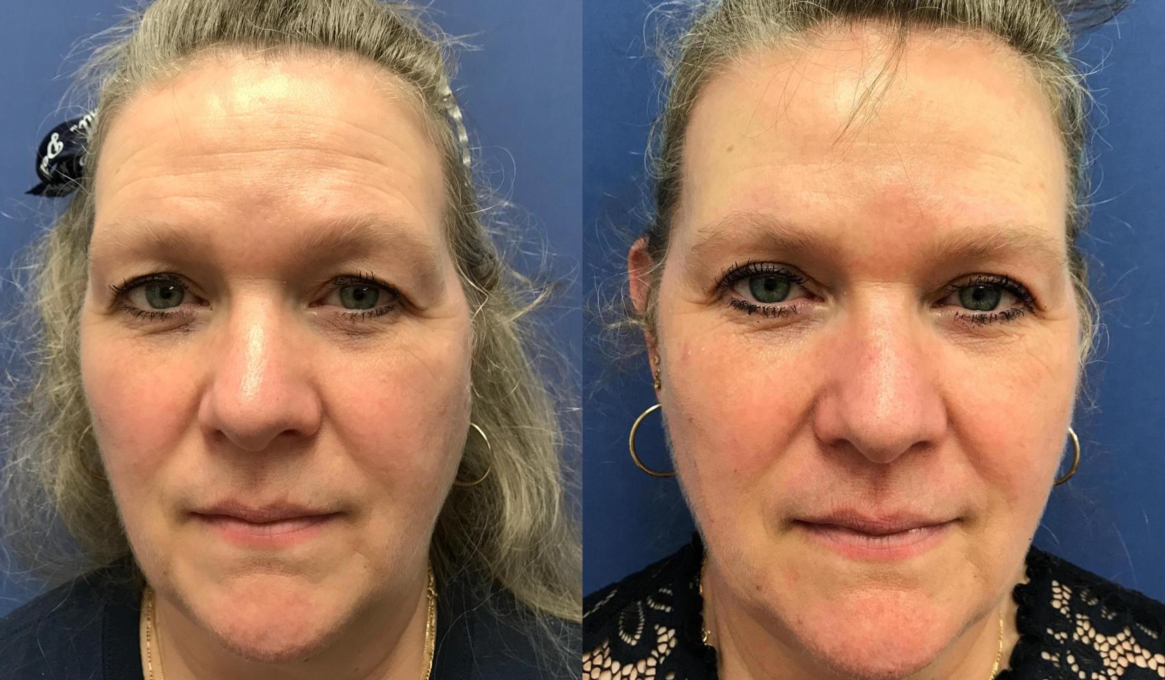 Before & After Eyelid Surgery Case 200 Front View in Ypsilanti, MI