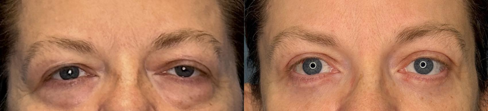 Before & After Eyelid Surgery Case 423 Front View in Ann Arbor, MI