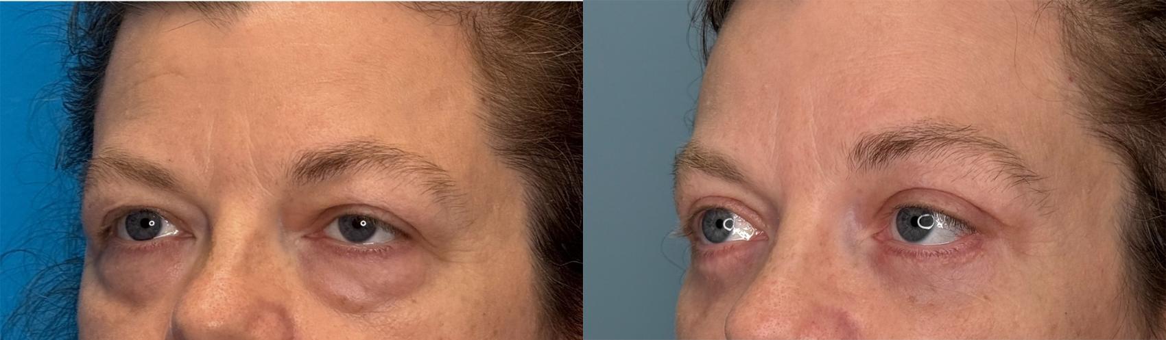 Before & After Eyelid Surgery Case 423 Left Side View in Ann Arbor, MI