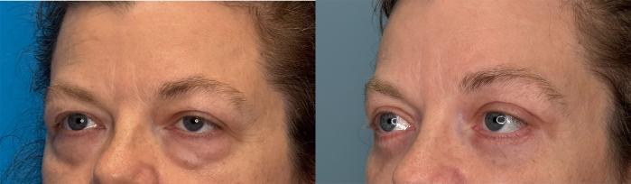 Before & After Eyelid Surgery Case 423 Left Side View in Ann Arbor, MI