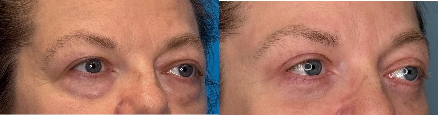 Before & After Eyelid Surgery Case 423 Right Side View in Ann Arbor, MI