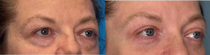 Before & After Eyelid Surgery Case 423 Right Side View in Ann Arbor, MI