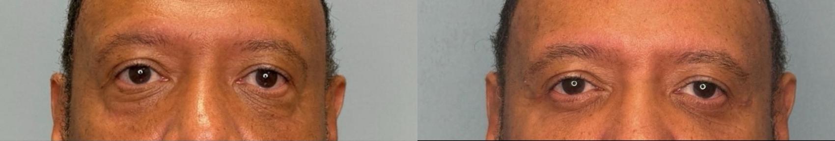 Before & After Eyelid Surgery Case 431 Front View in Ann Arbor, MI