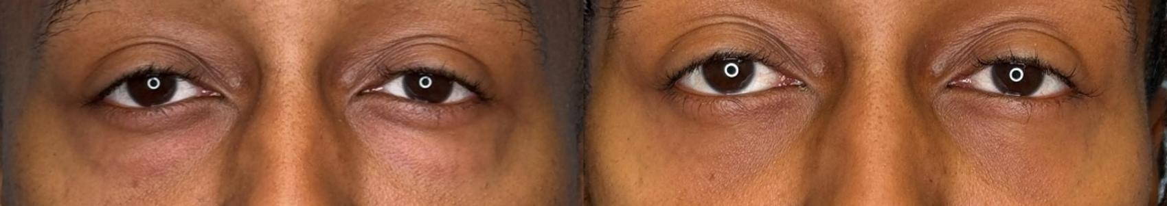Before & After Eyelid Surgery Case 446 Front View in Ann Arbor, MI