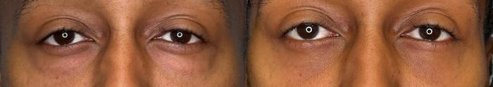 Before & After Eyelid Surgery Case 446 Front View in Ann Arbor, MI