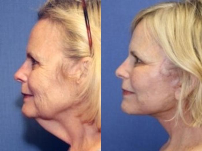 Before & After Facelift Case 1 Left Side View in Ypsilanti, MI