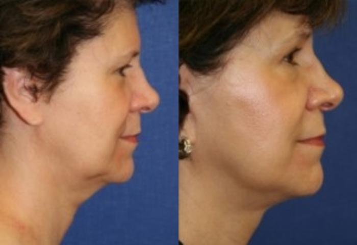 Before & After Facelift Case 143 Right Side View in Ypsilanti, MI