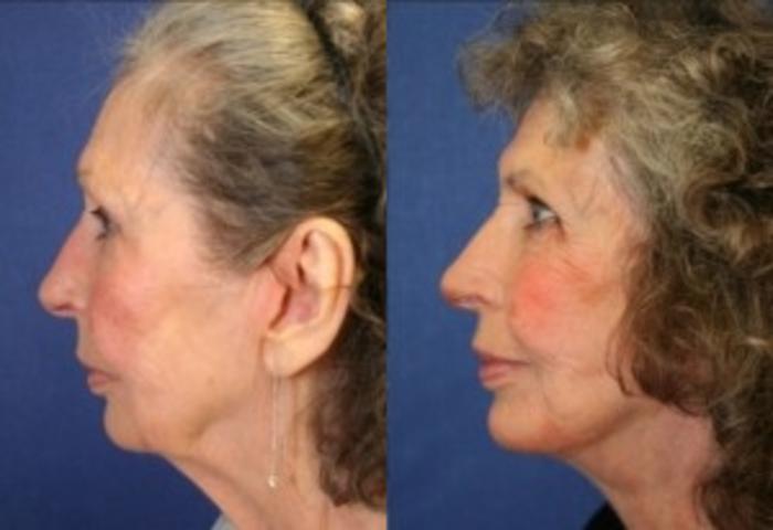 Before & After Facelift Case 144 Left Side View in Ypsilanti, MI