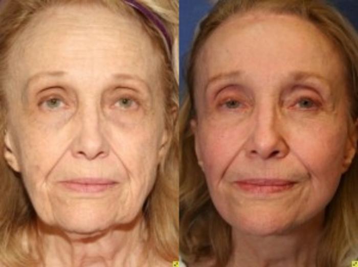 Before & After Facelift Case 145 Front View in Ypsilanti, MI