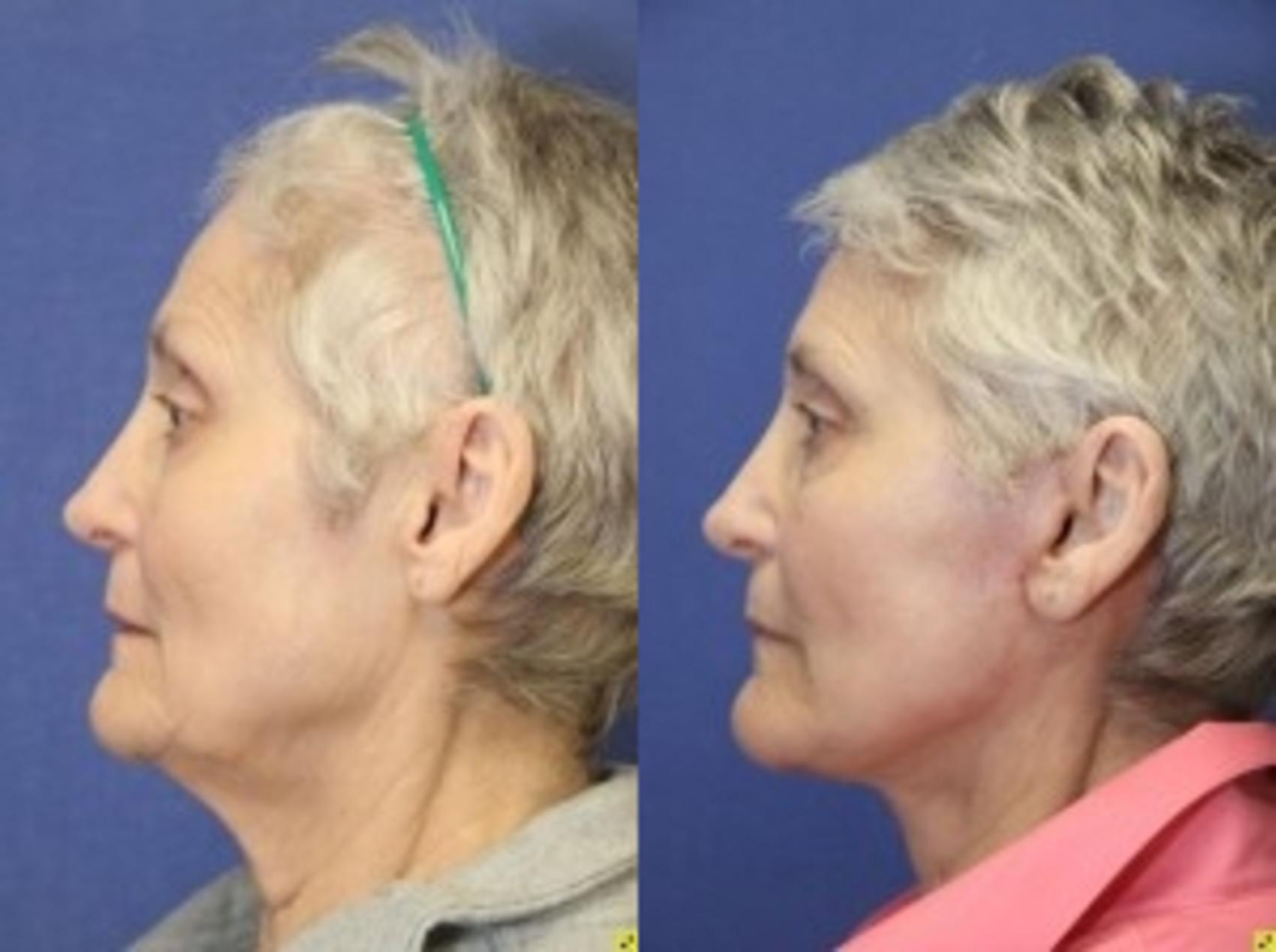 Before & After Facelift Case 146 Left Side View in Ypsilanti, MI