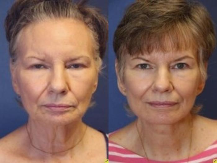 Before & After Facelift Case 148 Front View in Ypsilanti, MI