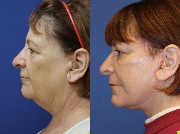 Before & After Facelift Case 149 Left Side View in Ypsilanti, MI