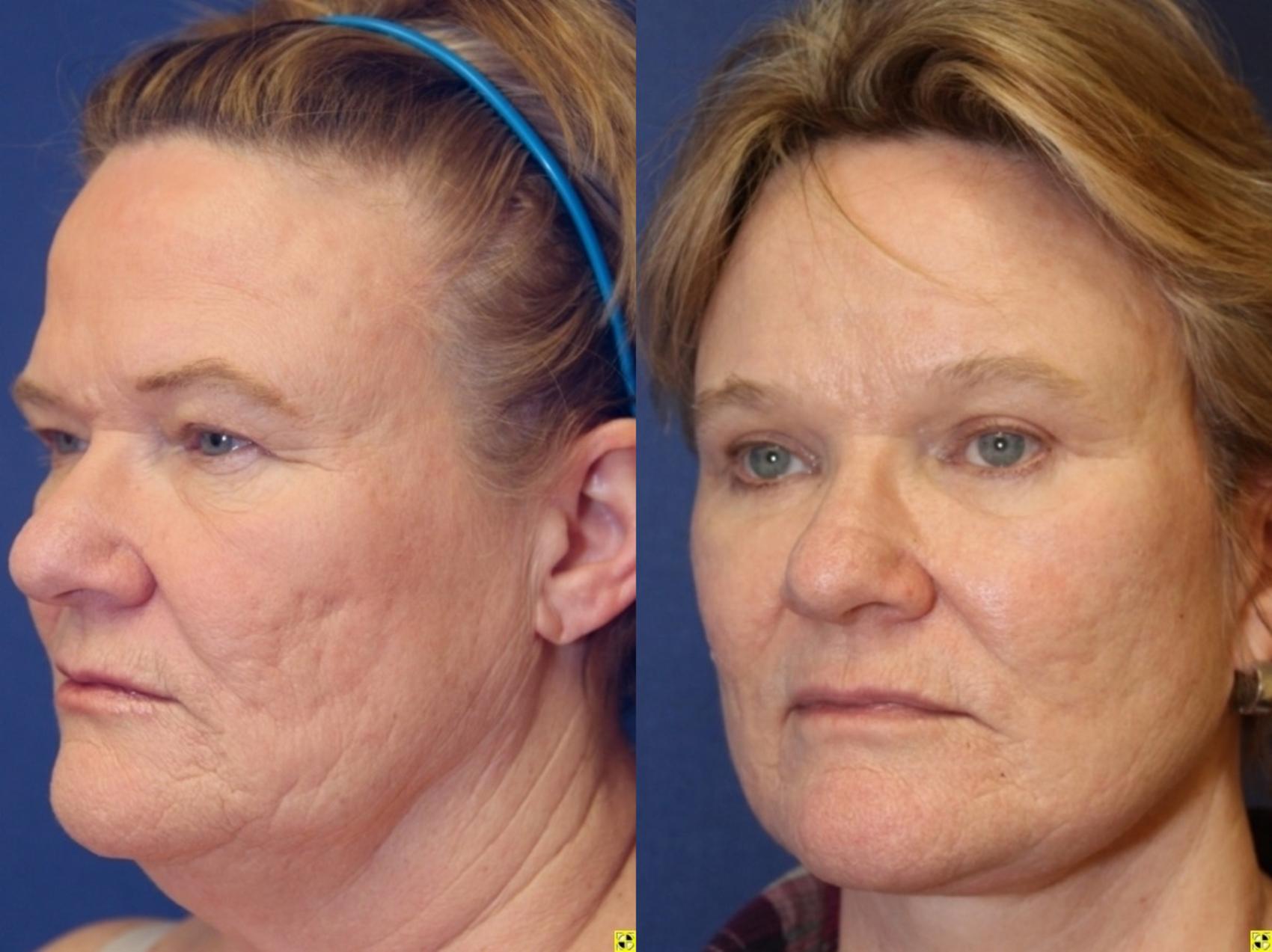 Before & After Facelift Case 150 Left Oblique View in Ypsilanti, MI