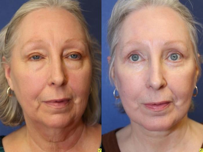 Before & After Facelift Case 151 Front View in Ypsilanti, MI