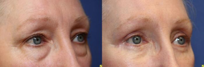 Before & After Facelift Case 151 Right Oblique View in Ypsilanti, MI