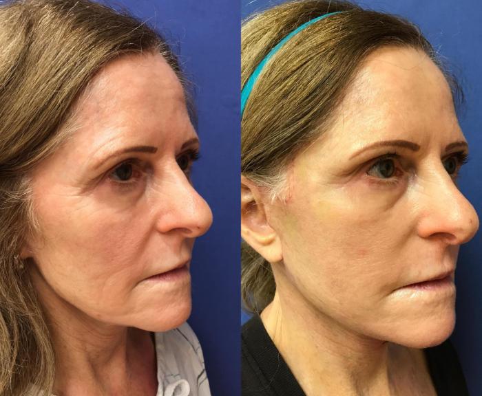 Before & After Facelift Case 153 Right Side View in Ypsilanti, MI