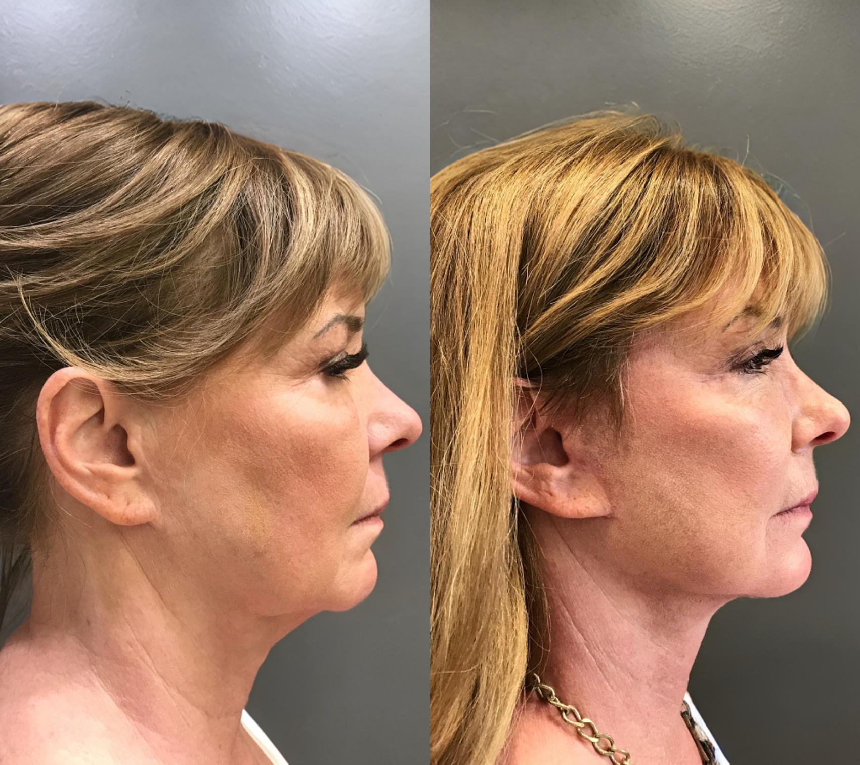 Before & After Facelift Case 403 Right Side View in Ann Arbor, MI