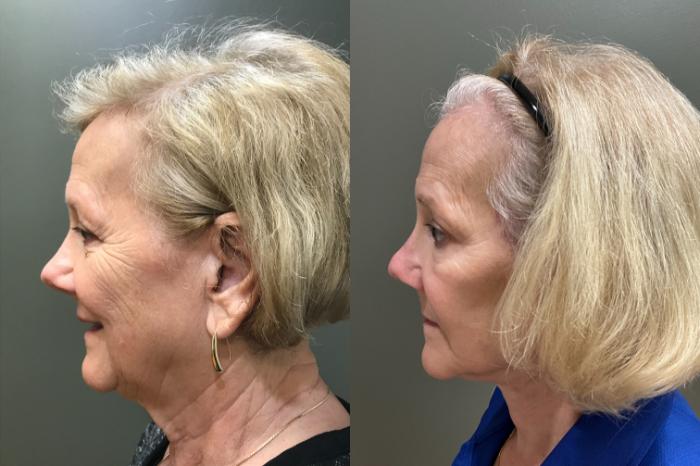 Before & After Facelift Case 420 Left Side View in Ann Arbor, MI