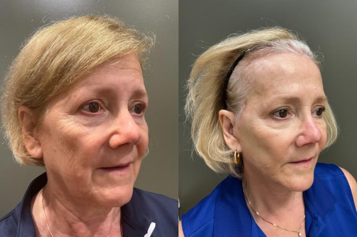 Before & After Facelift Case 420 Right Side View in Ann Arbor, MI