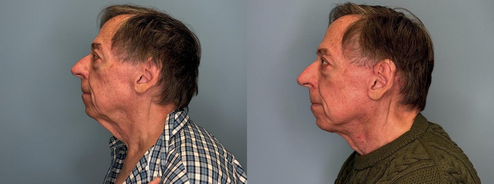 Before & After Neck Lift Case 439 Left Side View in Ann Arbor, MI