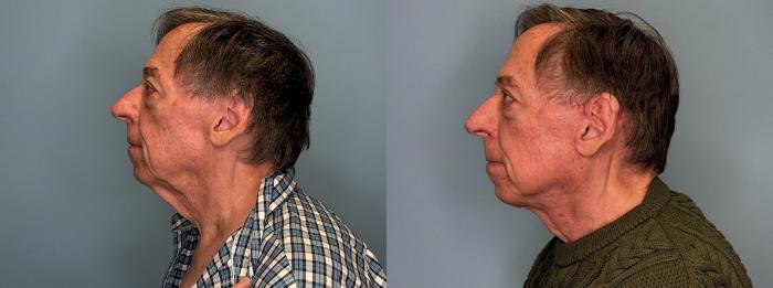 Before & After Neck Lift Case 439 Left Side View in Ann Arbor, MI