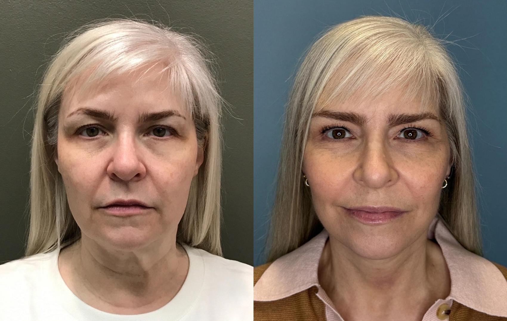 Before & After Facelift Case 444 Left Oblique View in Ann Arbor, MI