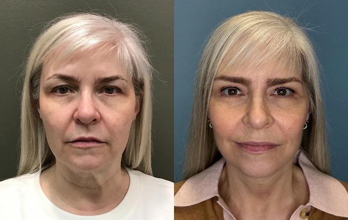 Before & After Facelift Case 444 Left Oblique View in Ann Arbor, MI