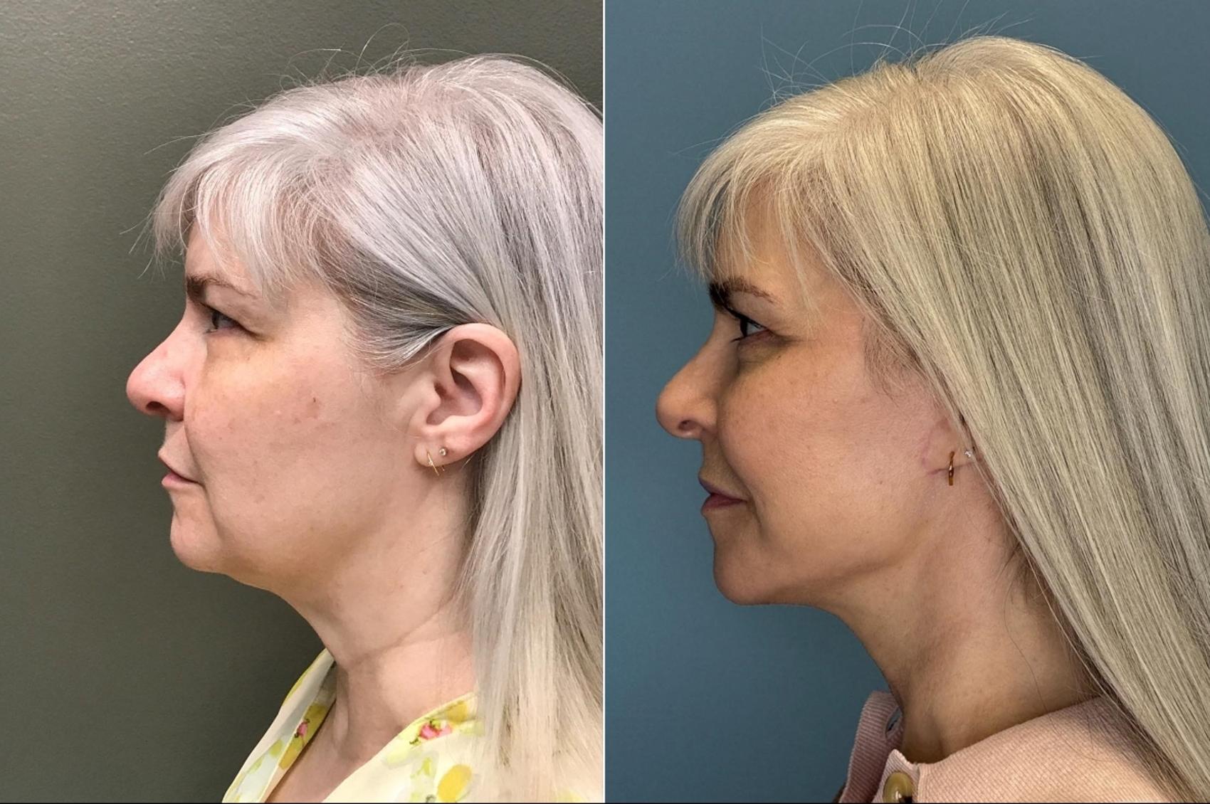 Before & After Facelift Case 444 Left Side View in Ann Arbor, MI