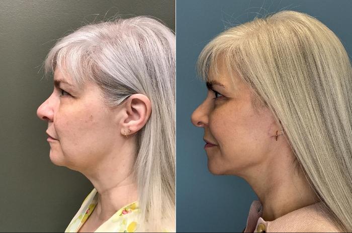 Before & After Facelift Case 444 Left Side View in Ann Arbor, MI