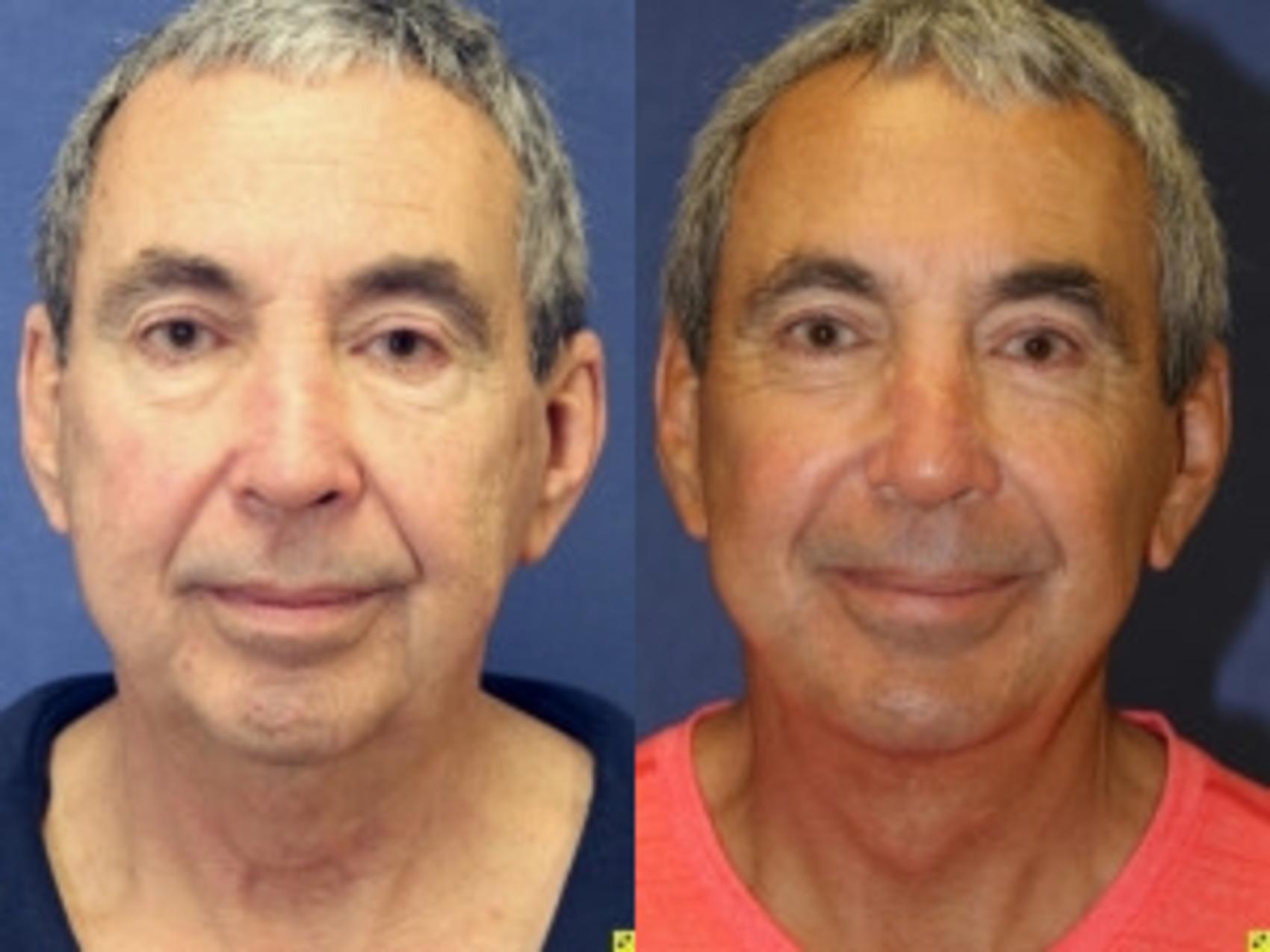 Before & After Facelift Case 5 Front View in Ypsilanti, MI