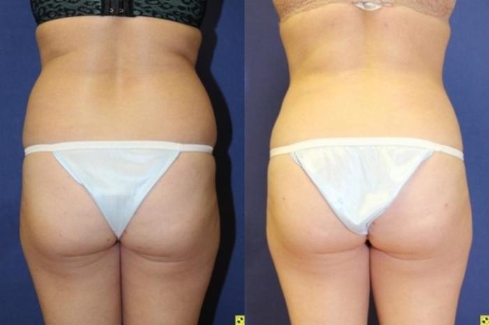 Before & After Fat Grafting Case 268 Back View in Ann Arbor, MI