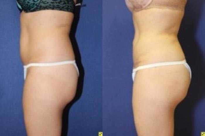 Before & After Fat Grafting Case 268 Left Side View in Ann Arbor, MI