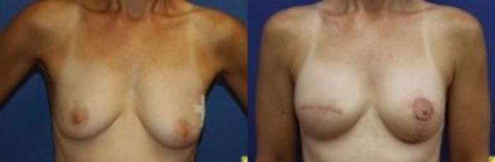 Before & After Fat Grafting Case 99 Front View in Ypsilanti, MI