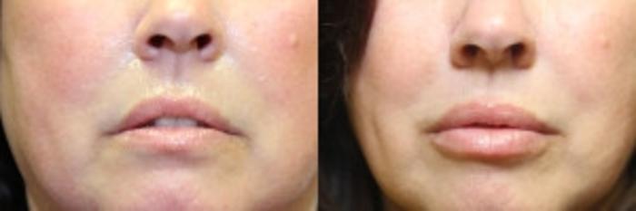 Before & After Lip Augmentation Case 227 Front View in Ypsilanti, MI