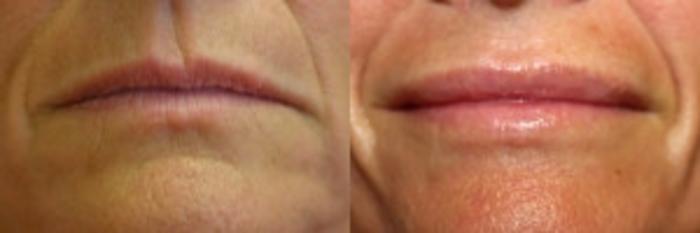 Before & After Lip Augmentation Case 228 Front View in Ypsilanti, MI