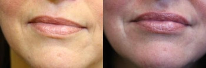 Before & After Lip Augmentation Case 229 Front View in Ann Arbor, MI