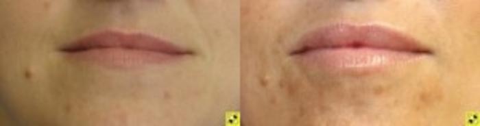 Before & After Lip Augmentation Case 230 Front View in Ann Arbor, MI
