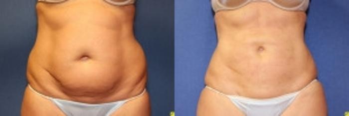 Before & After Liposuction Case 232 Front View in Ann Arbor, MI