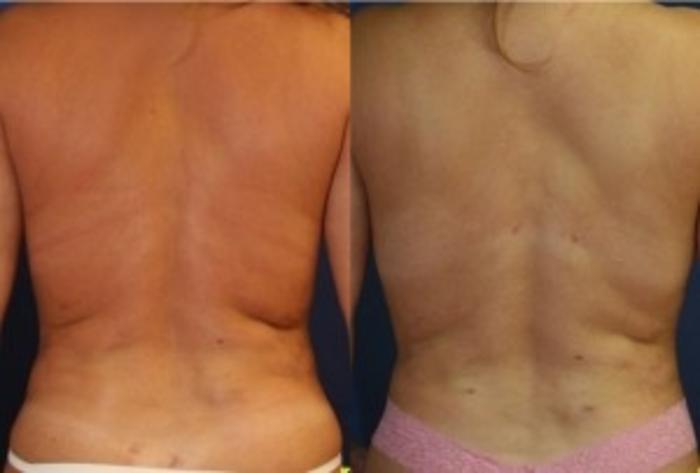 Before & After Liposuction Case 233 Back View in Ann Arbor, MI
