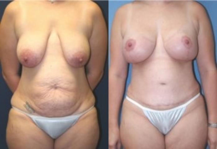 Before & After Liposuction Case 234 Front View in Ann Arbor, MI