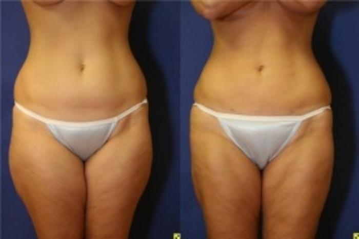 Before & After Liposuction Case 235 Front View in Ypsilanti, MI