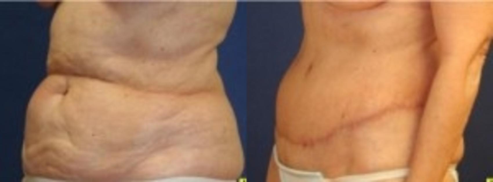 Before & After Tummy Tuck Case 236 Left Oblique View in Ann Arbor, MI