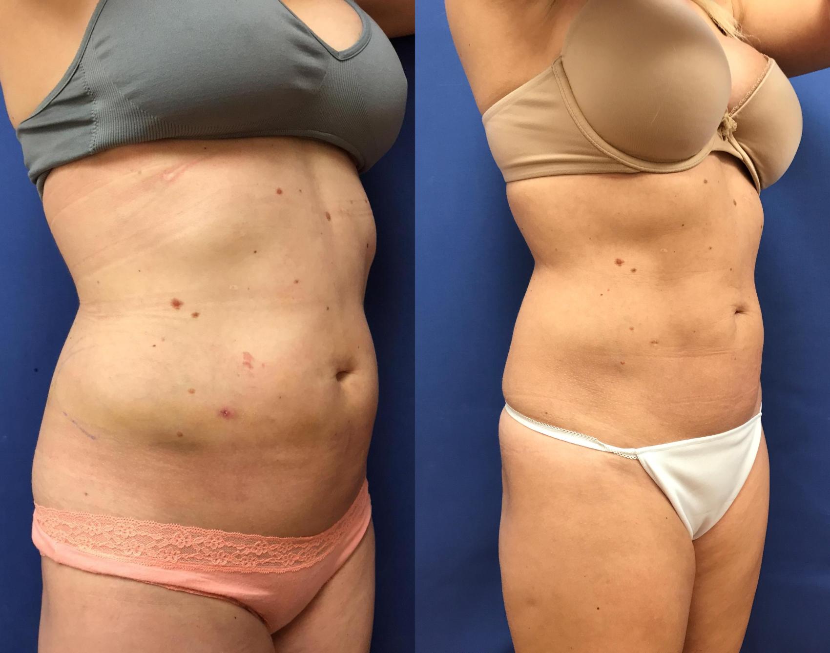 Before & After Liposuction Case 237 Right Oblique View in Ann Arbor, MI