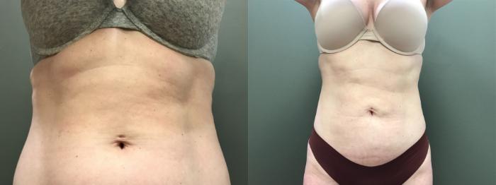 Before & After Liposuction Case 400 Front View in Ann Arbor, MI